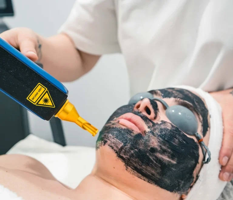 Carbon Peel