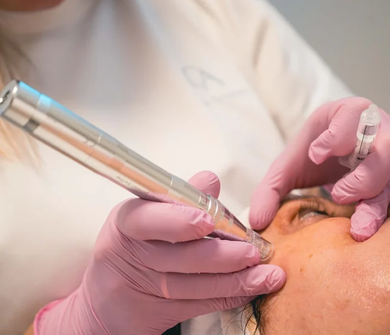 Microneedling